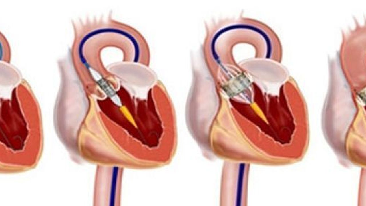 KSÜ TIP FAKÜLTESİ BİR İLKE DAHA İMZA ATTI: 96 YAŞINDAKİ HASTANIN AORT KAPAĞI AMELİYATSIZ OLARAK DEĞİŞTİRİLDİ 